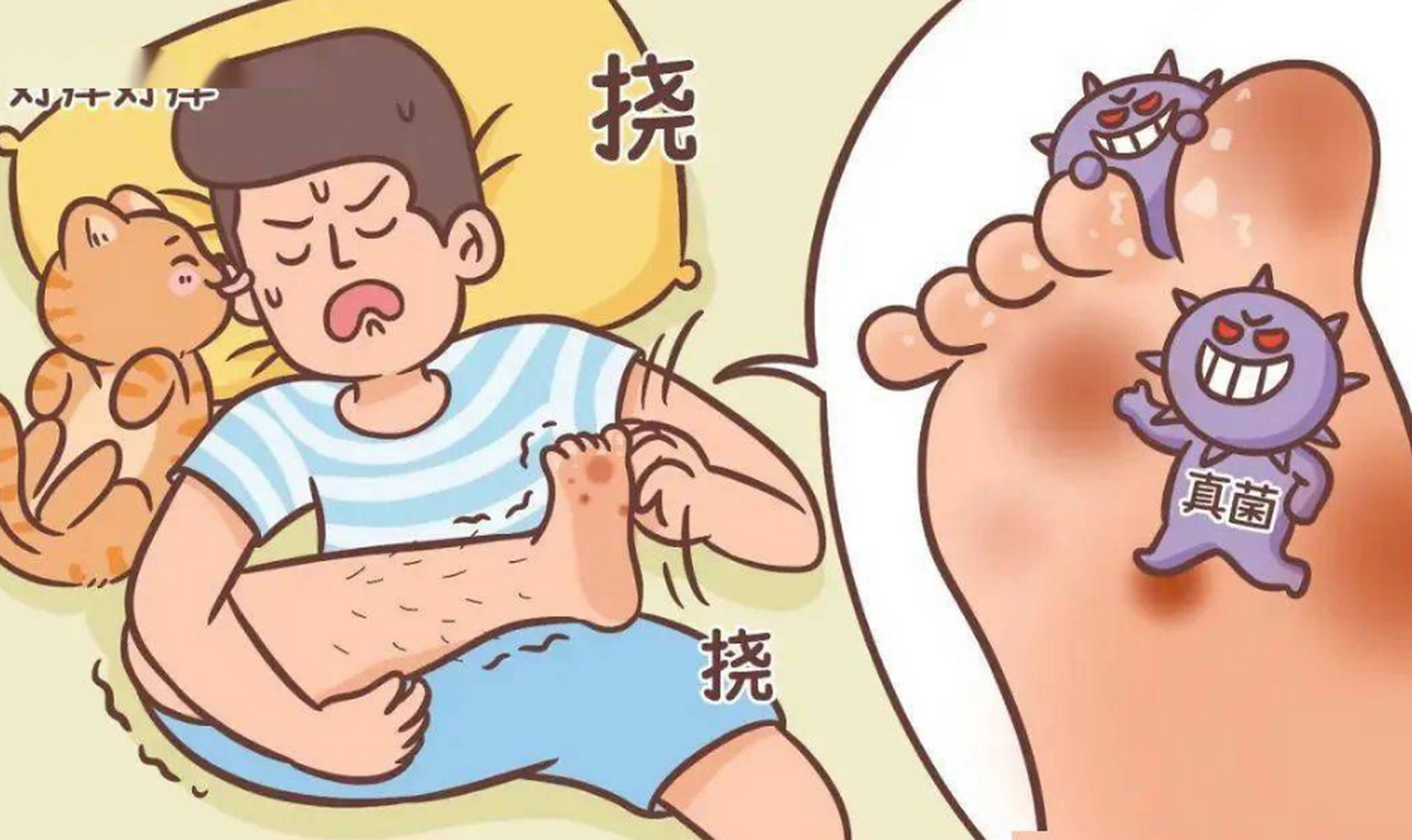 脚部脱皮是#脚气# 的典型症状,脚气是现在生活中发病率非常高的一种