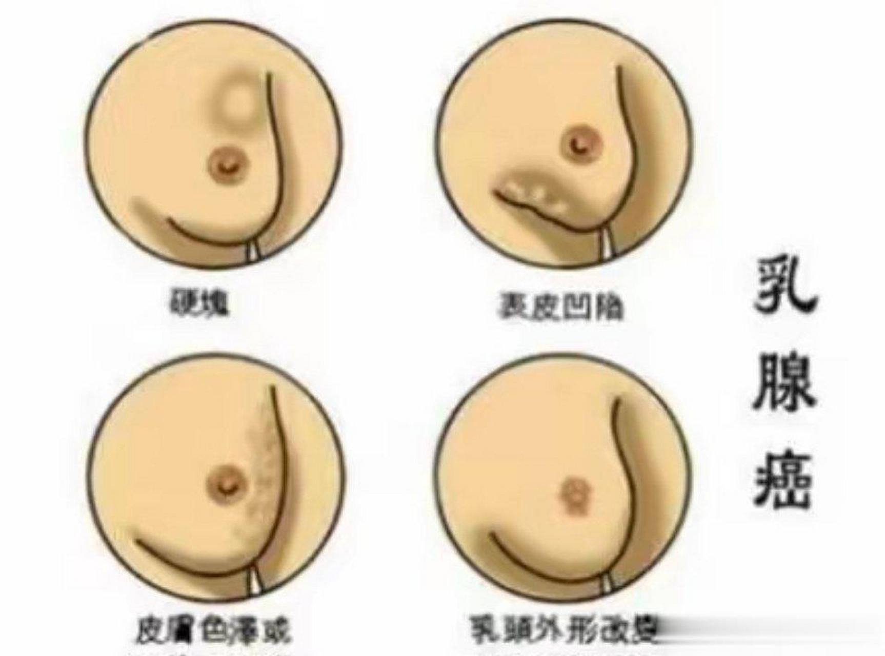 乳腺癌晚期早期图片