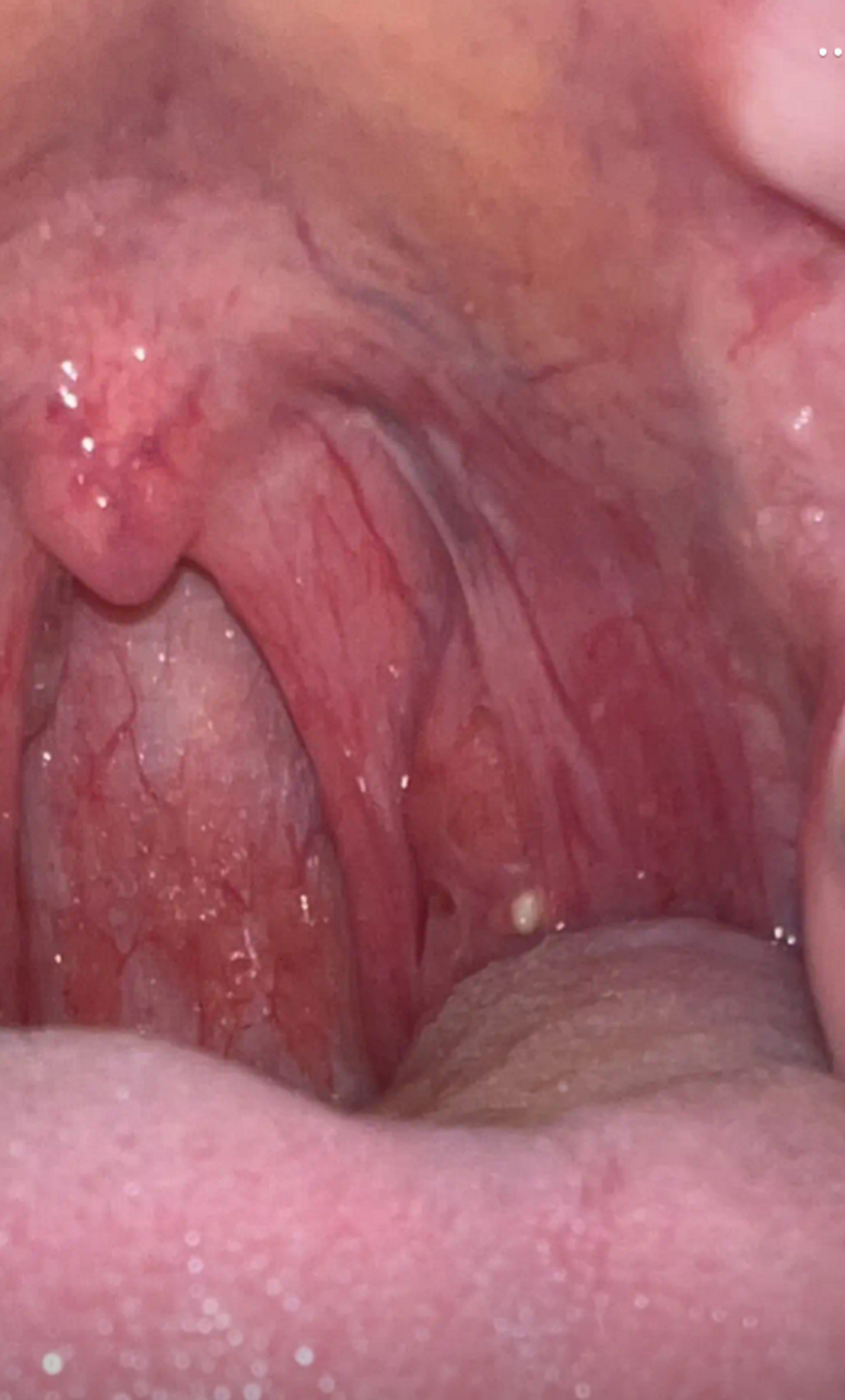 屁股们,喉咙长出白色的颗粒是什么,我拿牙签挤出来,过一个星期他还是