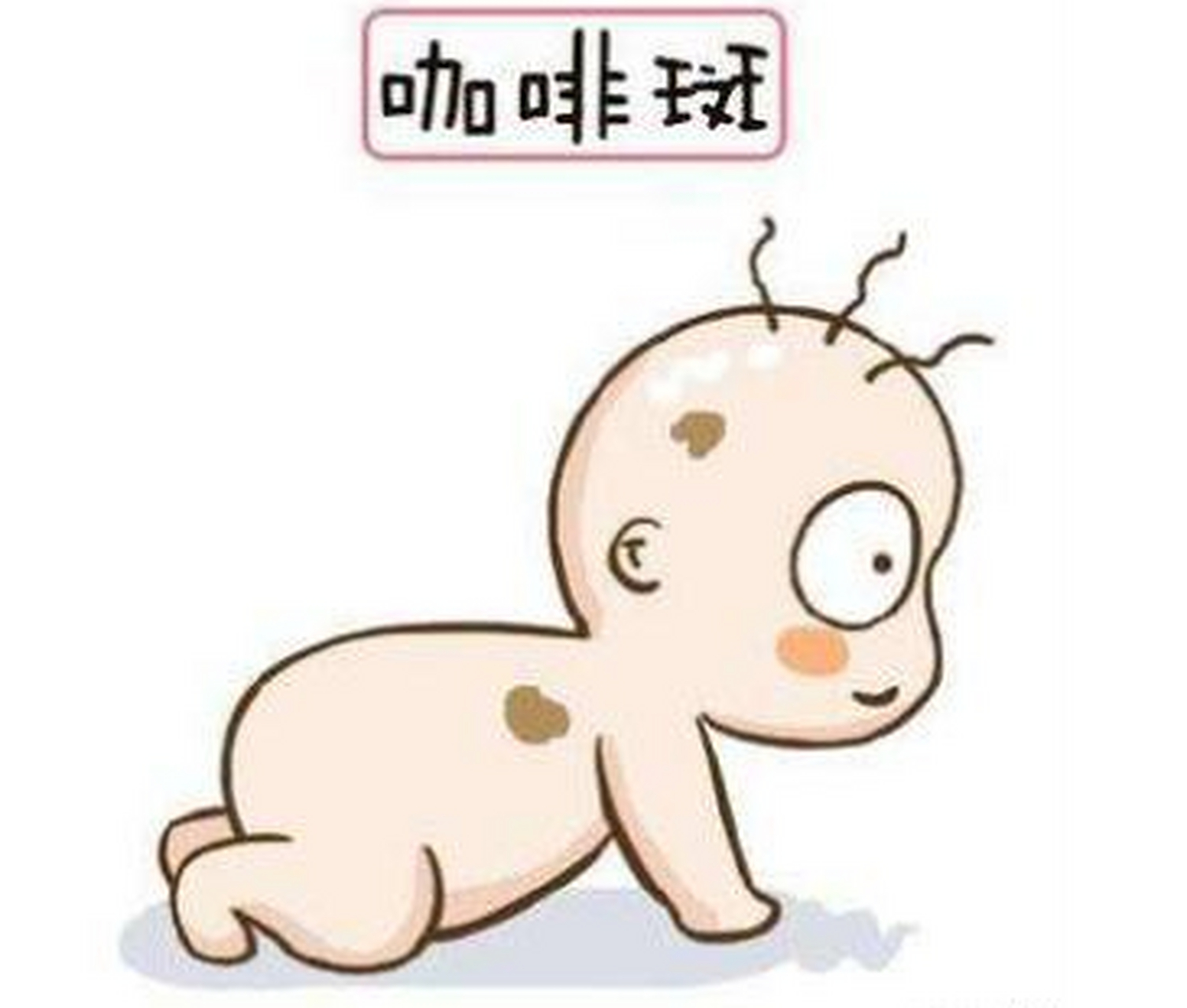 在大多数情况下,后背长咖啡斑不需要特别的治疗措施.