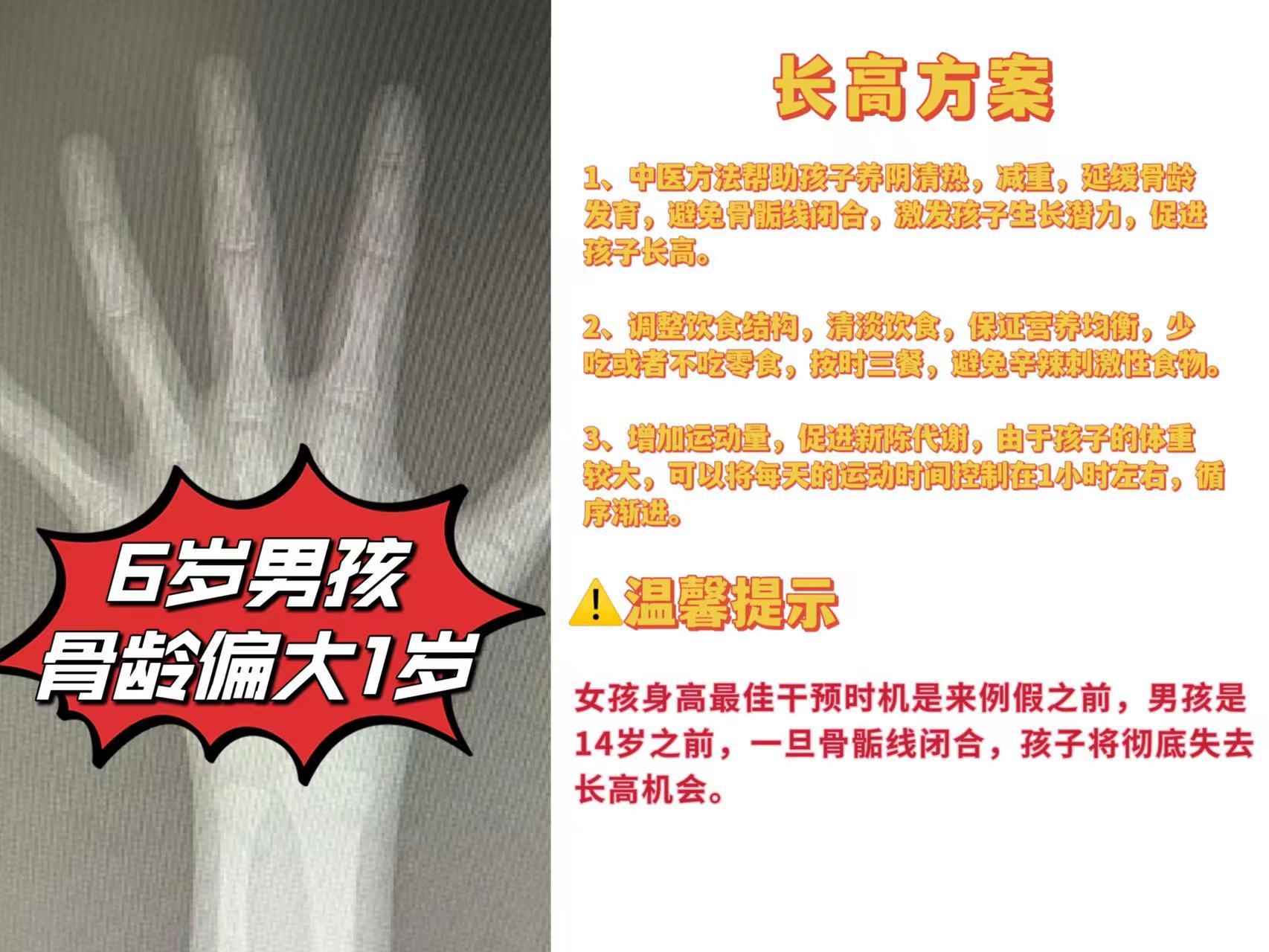 骨龄到底需不需要测?