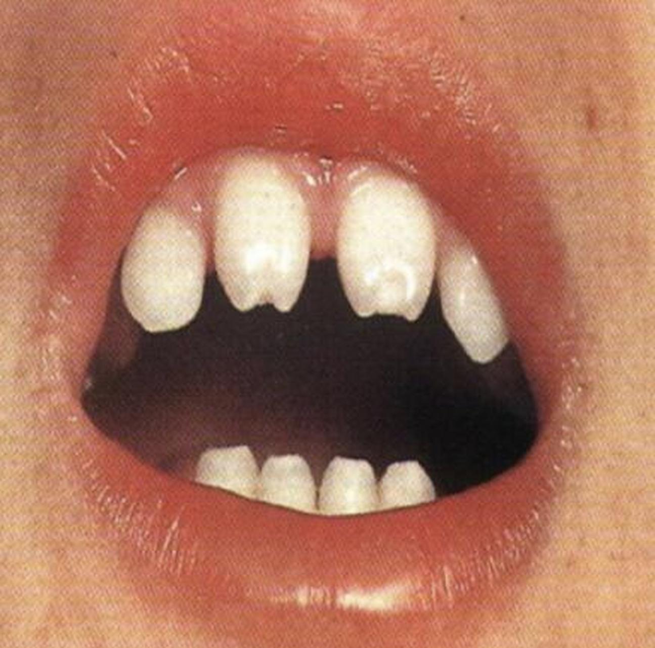 梅毒牙,又叫哈钦森齿,牙釉质发育不全,切牙呈半月形
