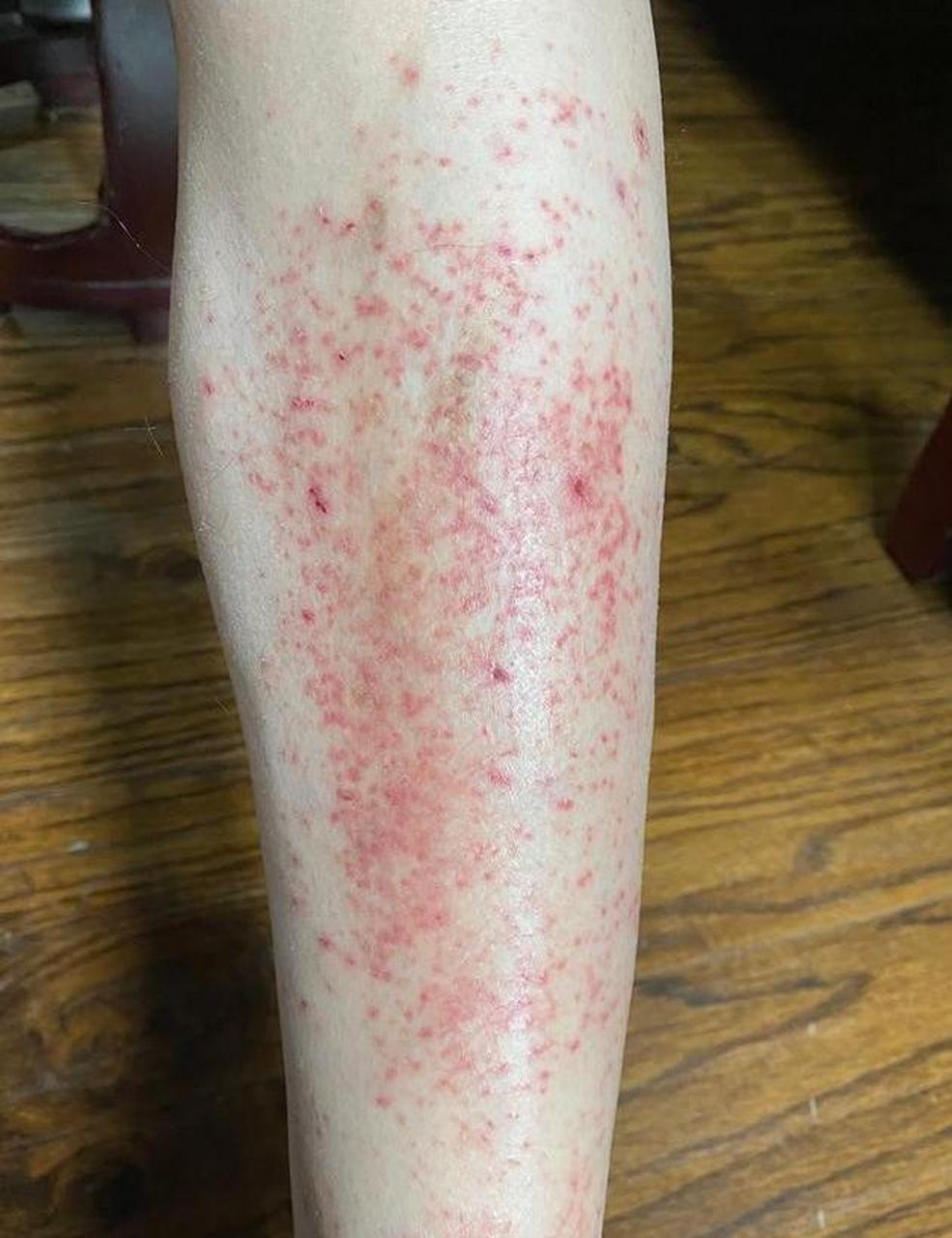 湿疹,从我们中医角度来看,多由血热,风邪,脾虚湿困等原因引起.