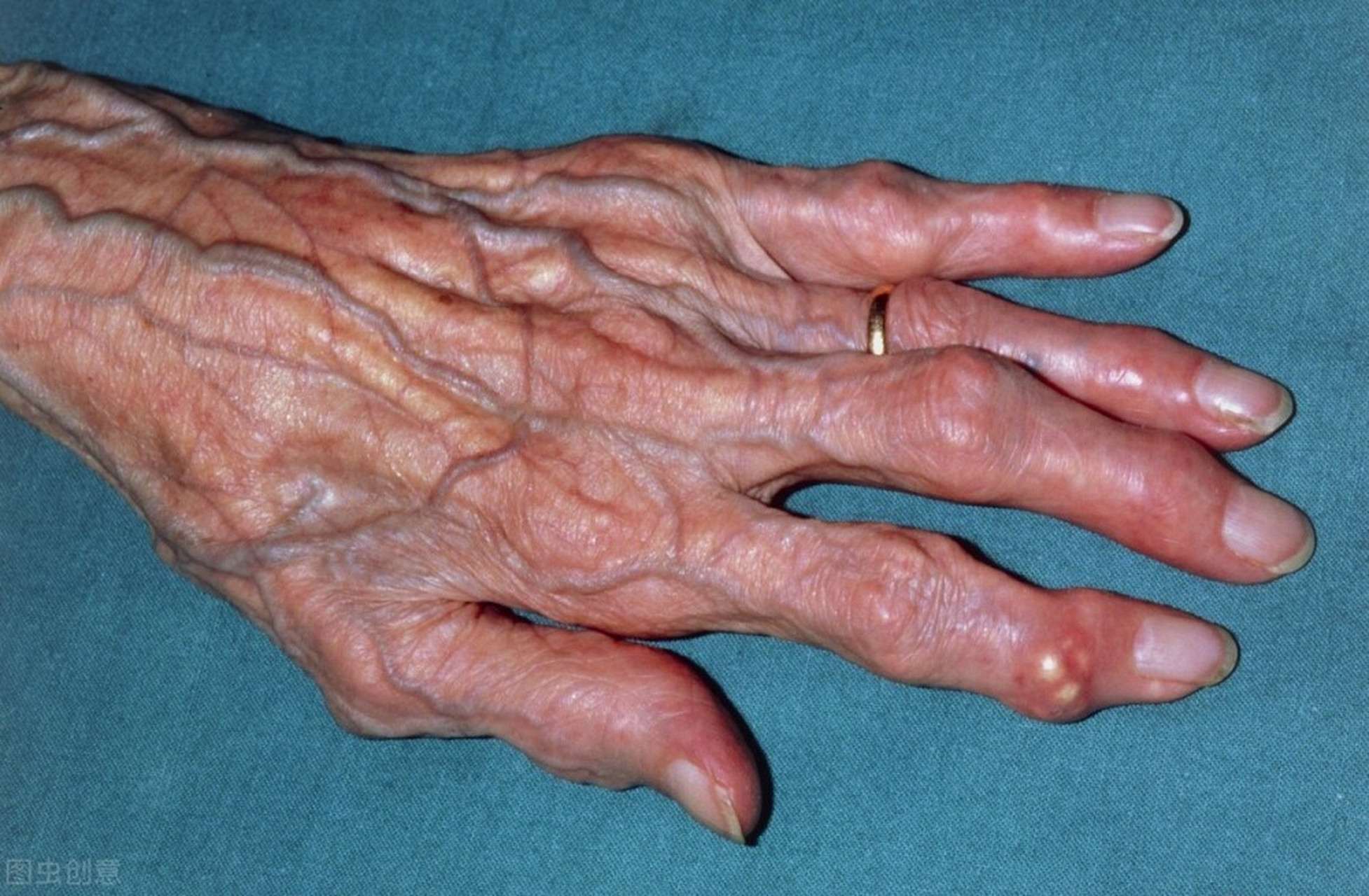 有这些症状,才是痛风  痛风是一种关节疾病,它的特征是关节红肿热痛