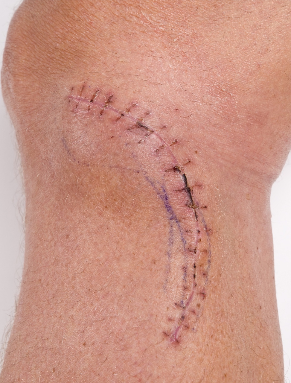 手术疤痕增生怎么办?