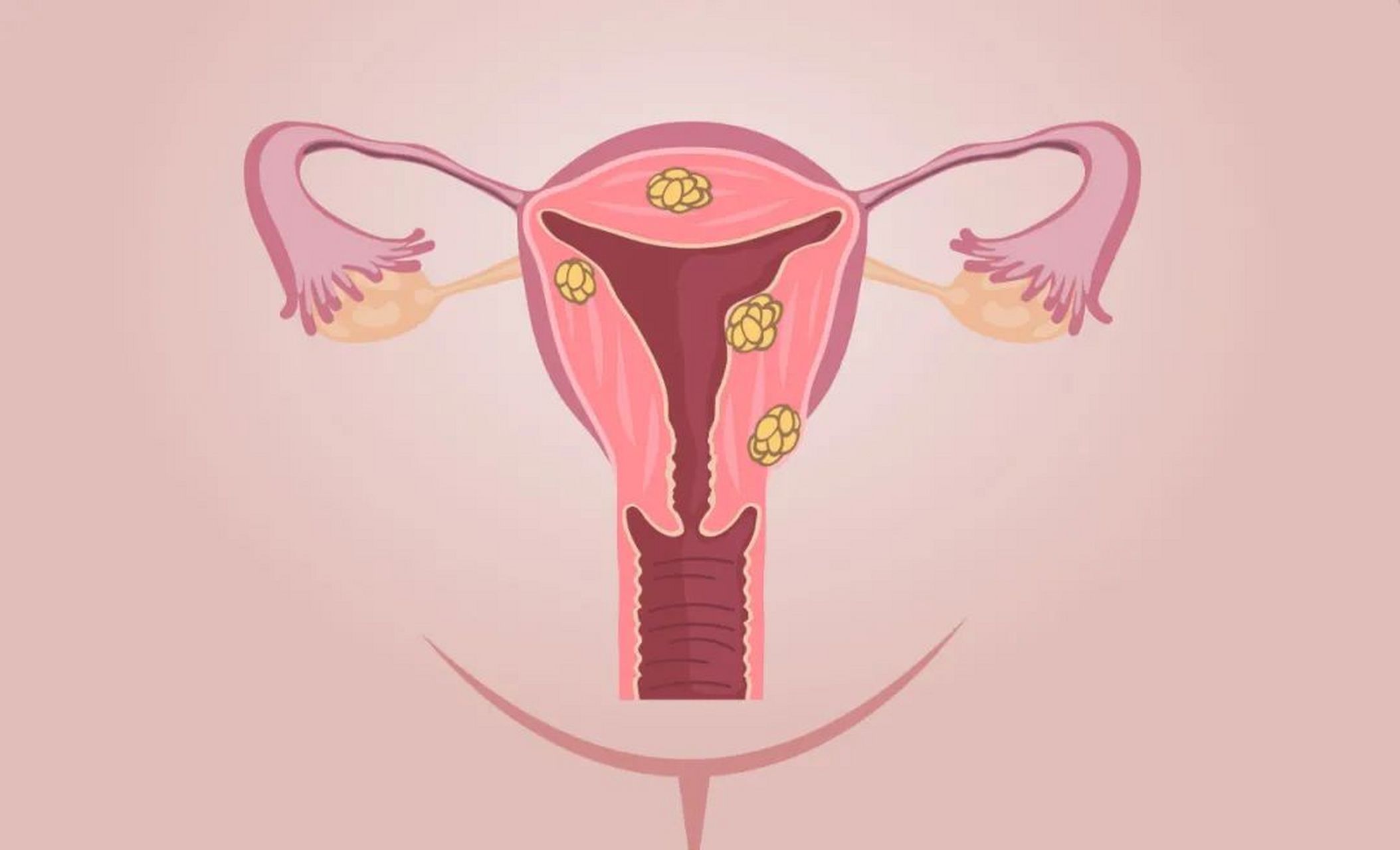 女性健康 中医怎么看子宫肌瘤?