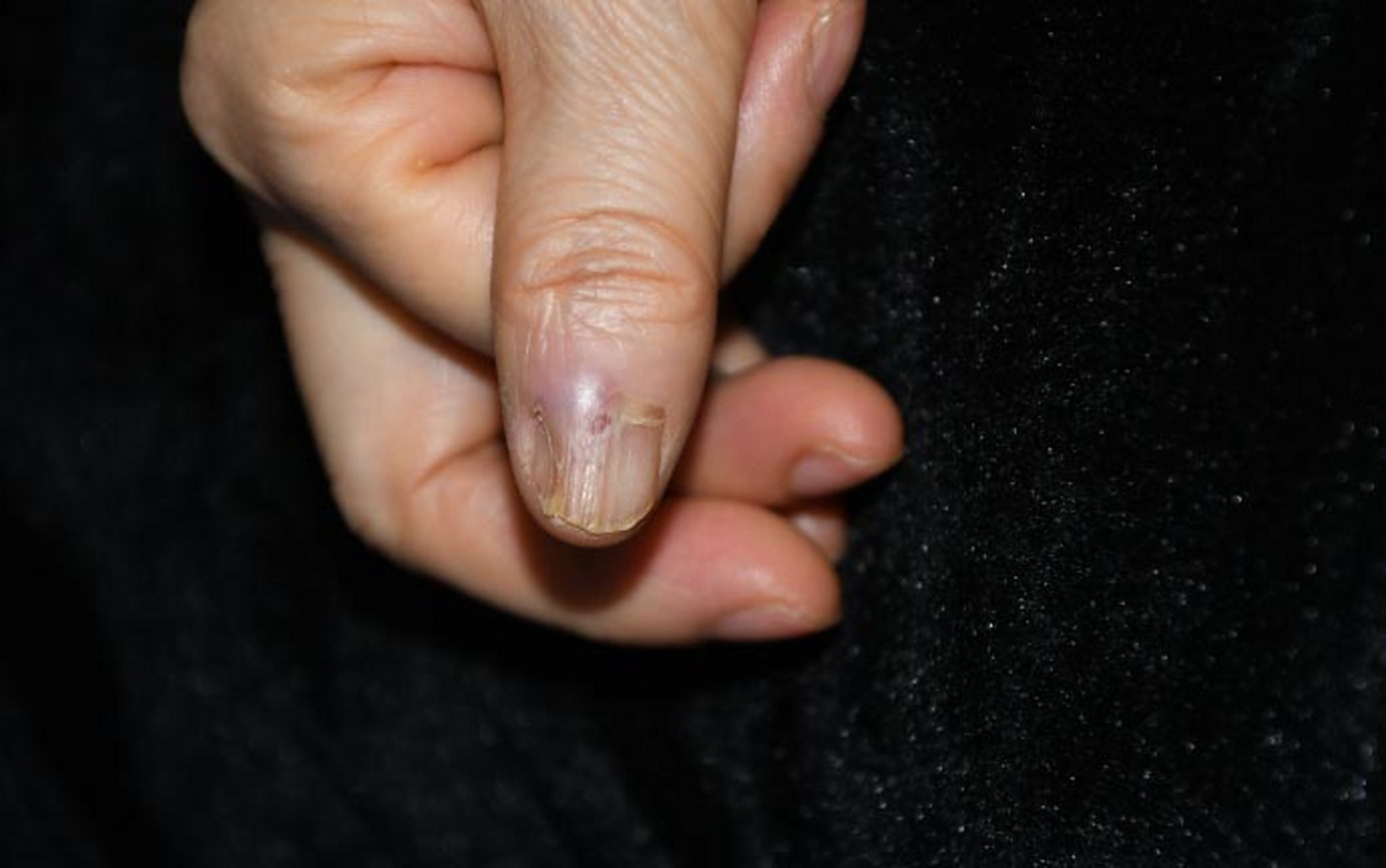 血管球瘤,常常异常疼痛,痛起来病人描述手指可以不要.