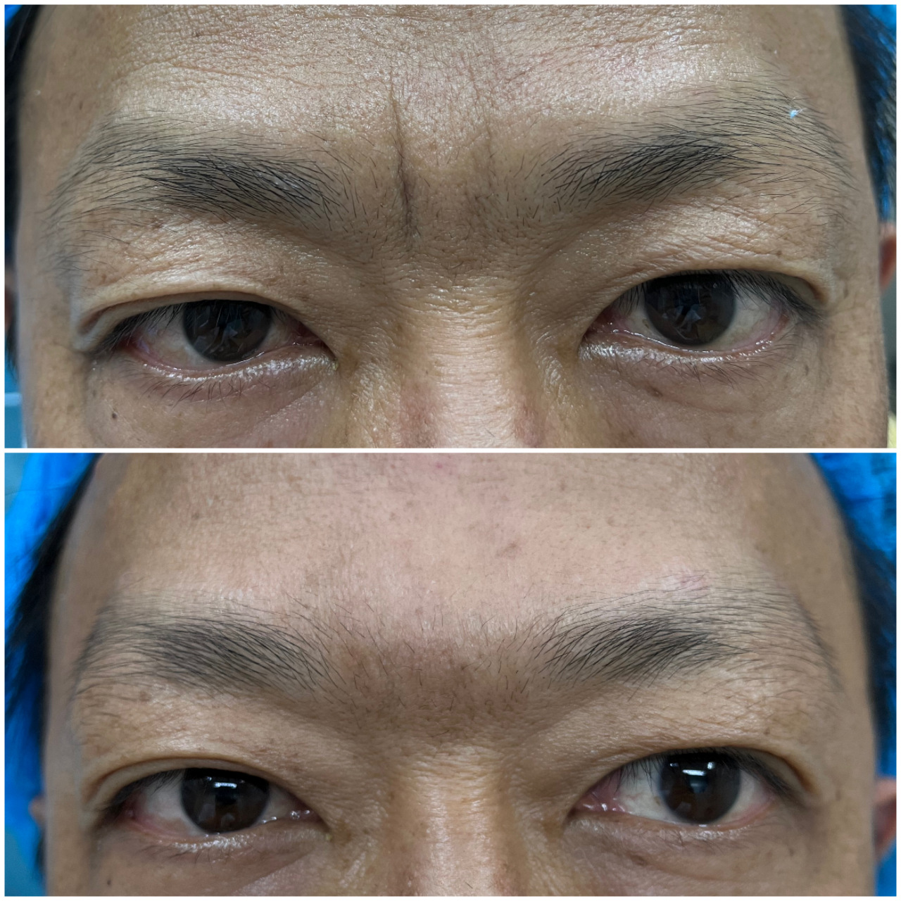 川字纹是打玻尿酸还是除皱针?