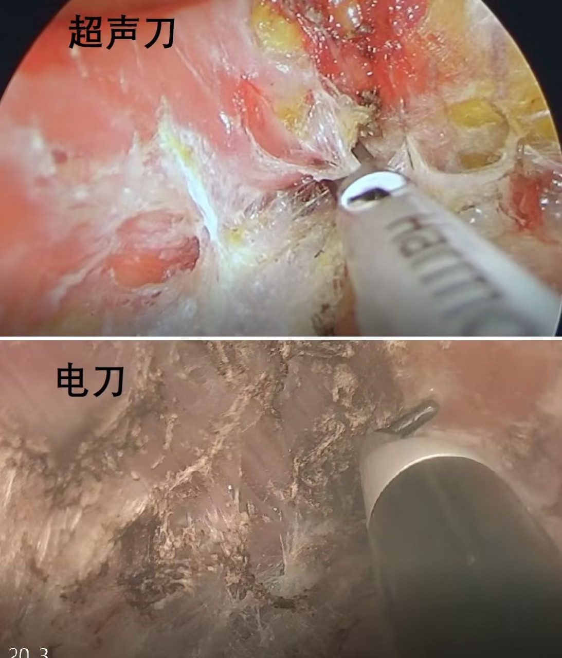 无焦痂 超声刀的热损伤相对更小 在隆胸手术中内窥镜 电刀相比传统的