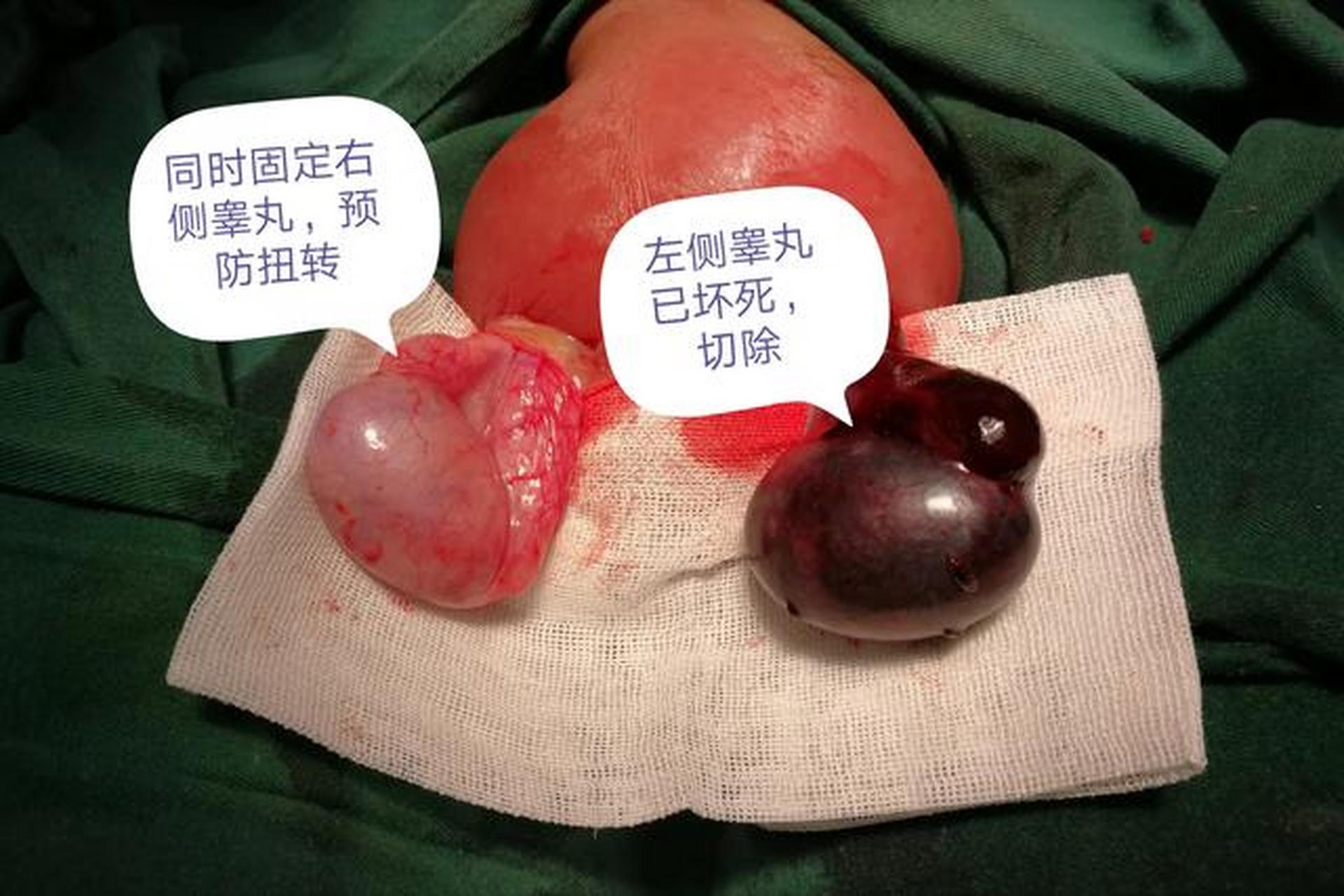 有的胎儿在发育时会产生一侧或两侧睾丸系膜过长,这样的孩子出生后