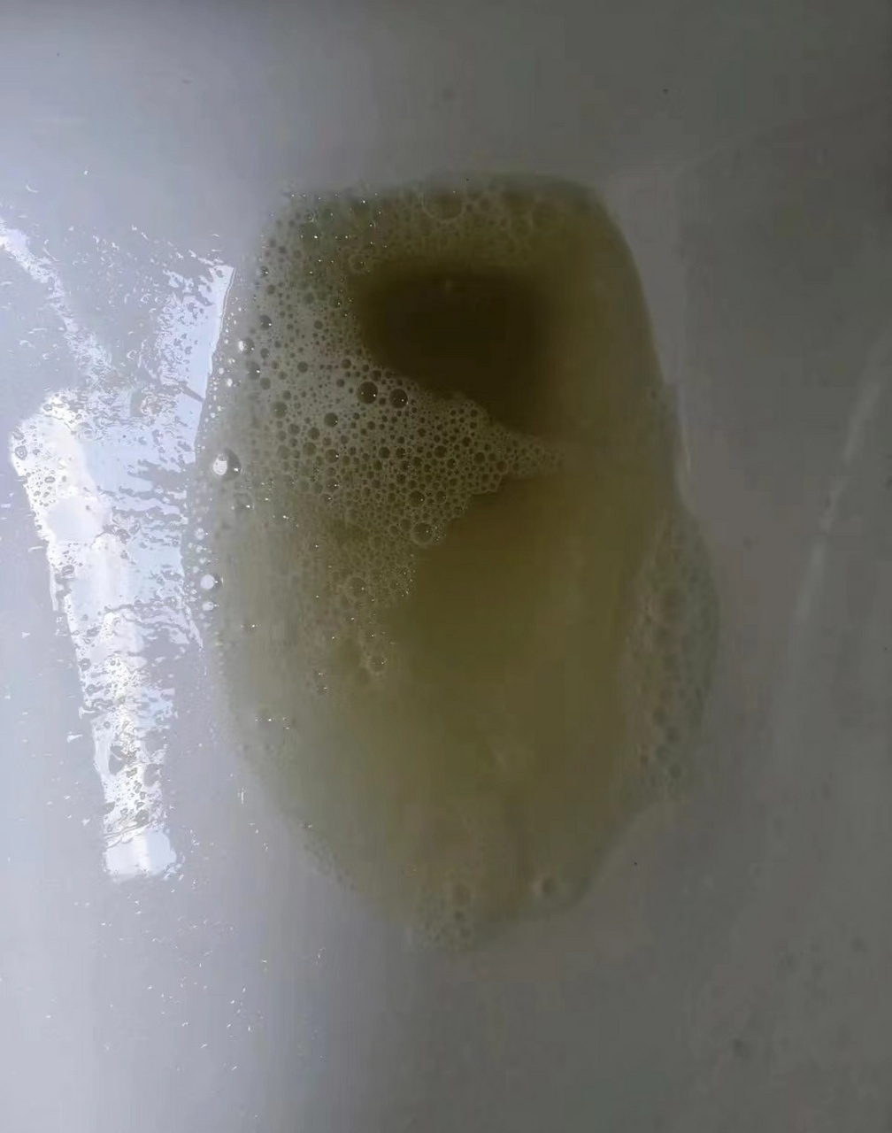 张女士近4个月来,经常发现尿中泡沫丰富,后经尿常规化验,发现蛋白4 .