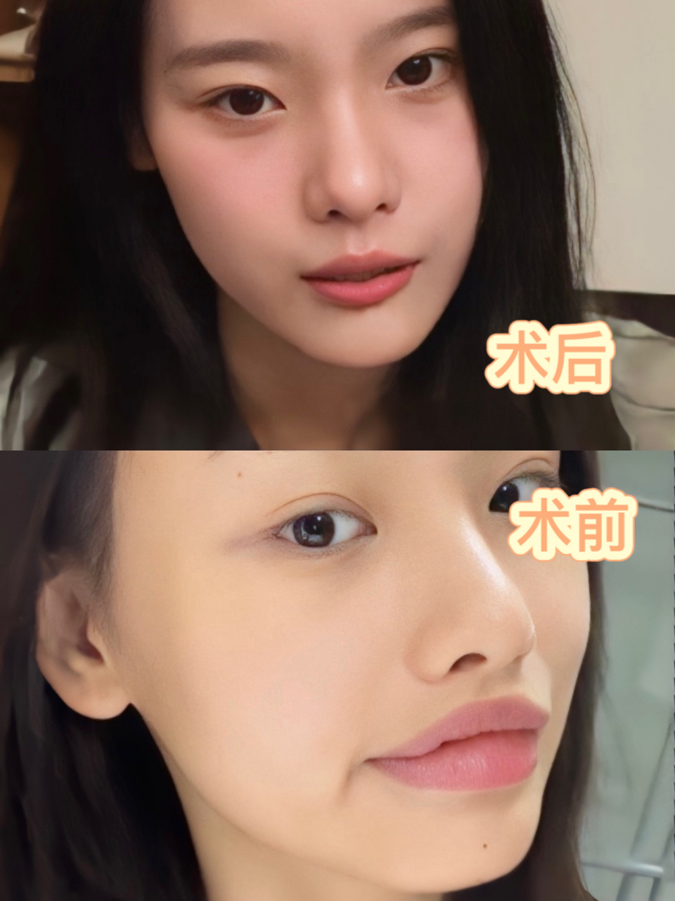 厚唇改薄整形手术价格 一直对自己的嘴巴不满意,我属于嘴唇挺厚的那种
