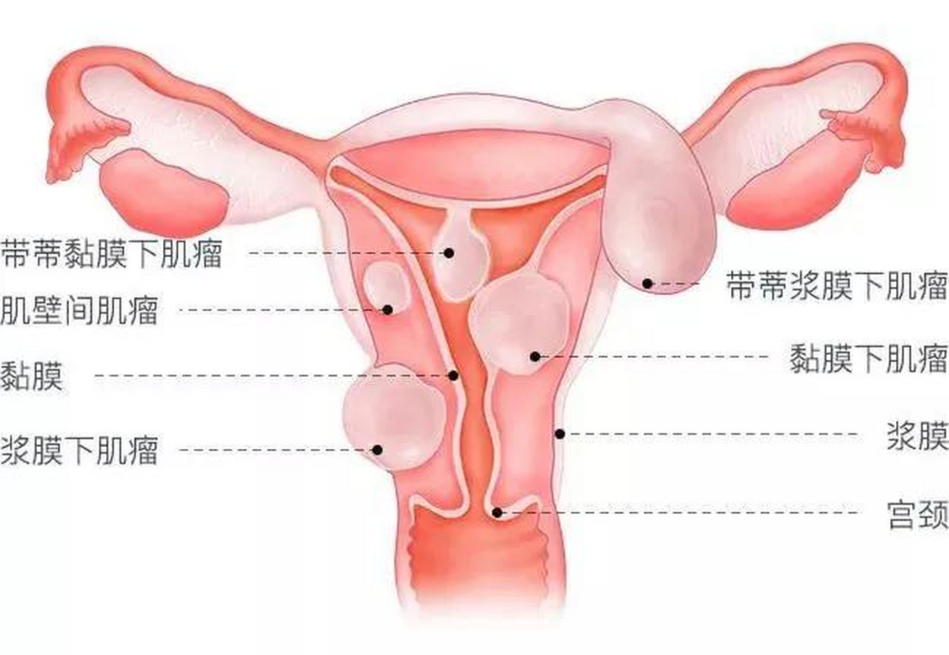 子宫体位置图片