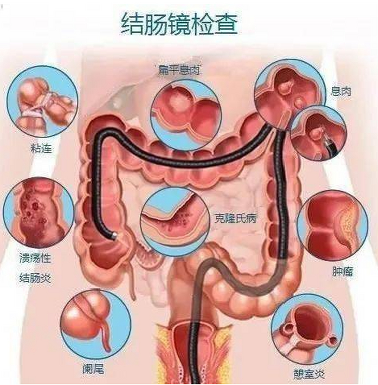 肠镜6张图片对应部位图片