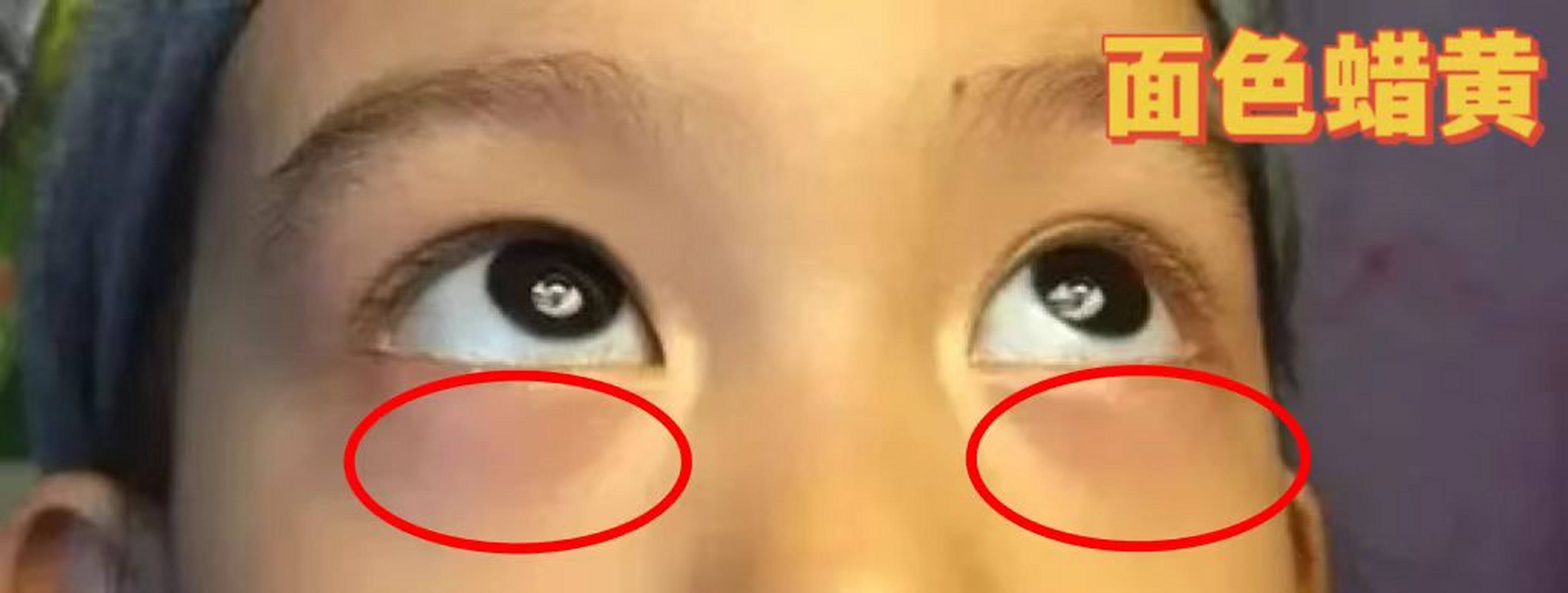 孩子面色蜡黄,浓浓的大眼袋,经常性咳嗽,多痰,到底是什么地方出了问题