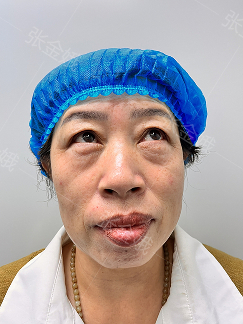 这位女士60岁左右,眼袋重度膨出,且伴随泪沟,皮肤松弛问题,是属于典型