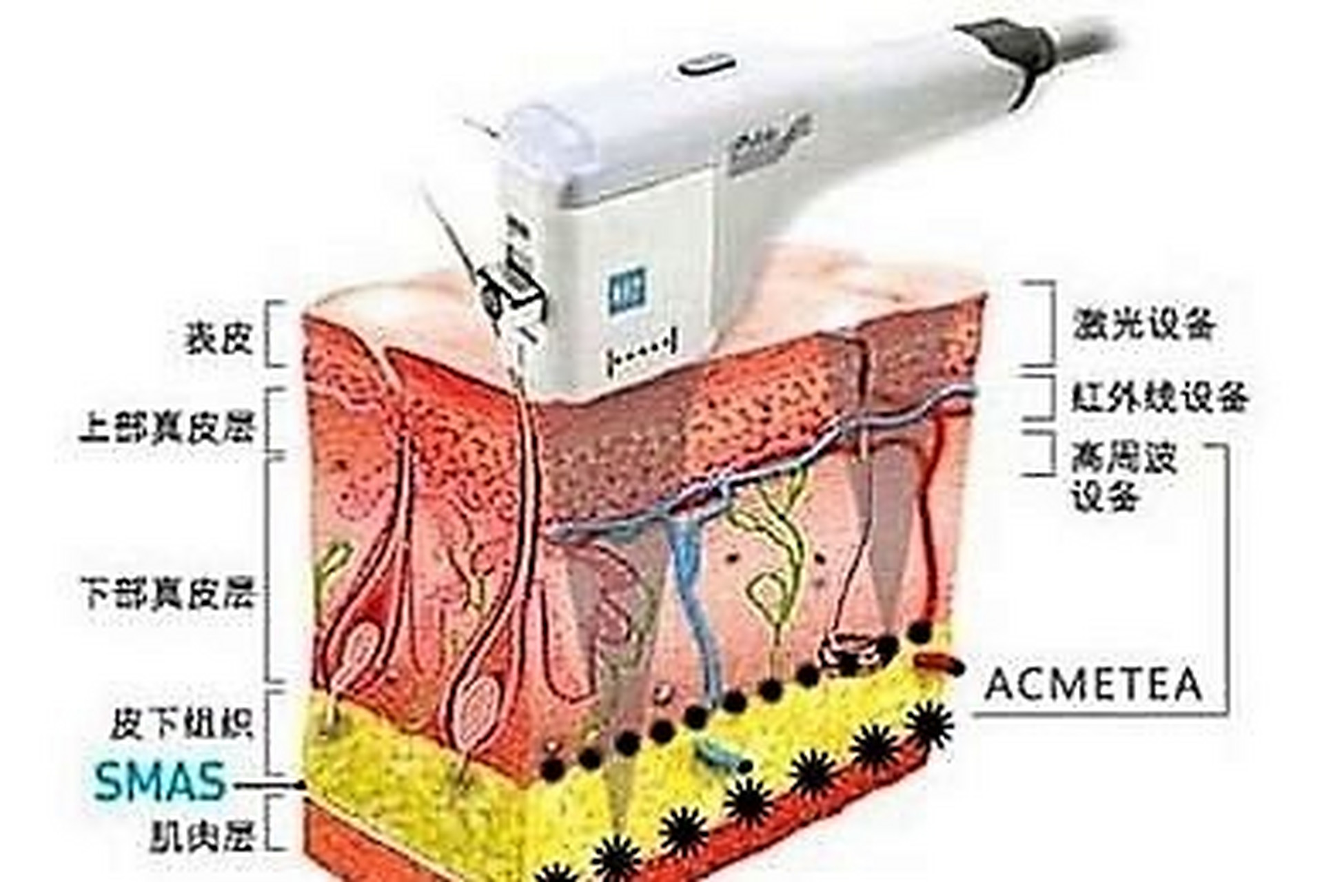 超声刀的原理和作用   原理是通过高分子能量波,对皮肤进行修复,使
