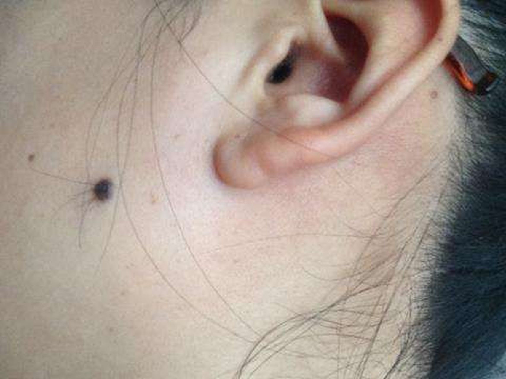 有的痣上有毛,有的痣上没毛都是正常现象,痣上长毛是因为痣里面有