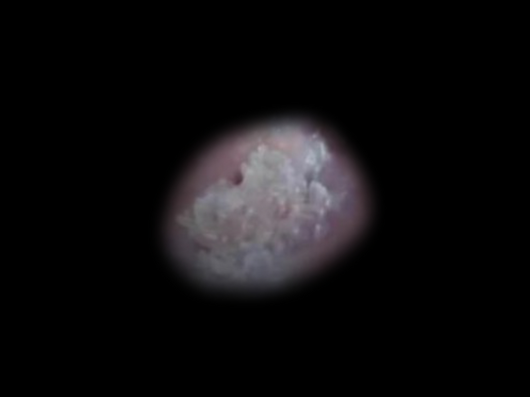 有必要做吗?  醋酸白试验是一种简单,快捷,低成本的尖锐湿疣诊断方法.