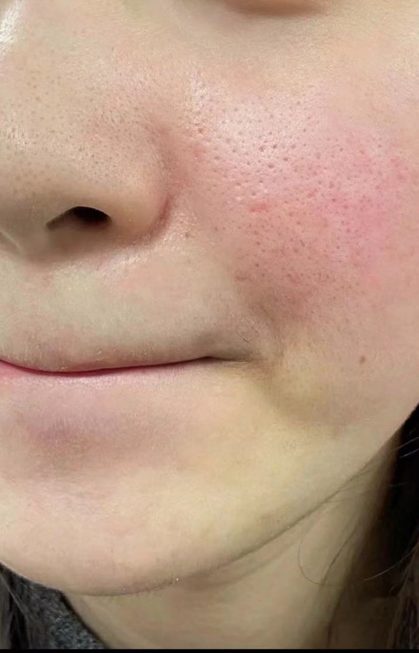 皮肤角质层是人体表面最外层的一层,由死亡的皮细胞和角蛋白等组成,起