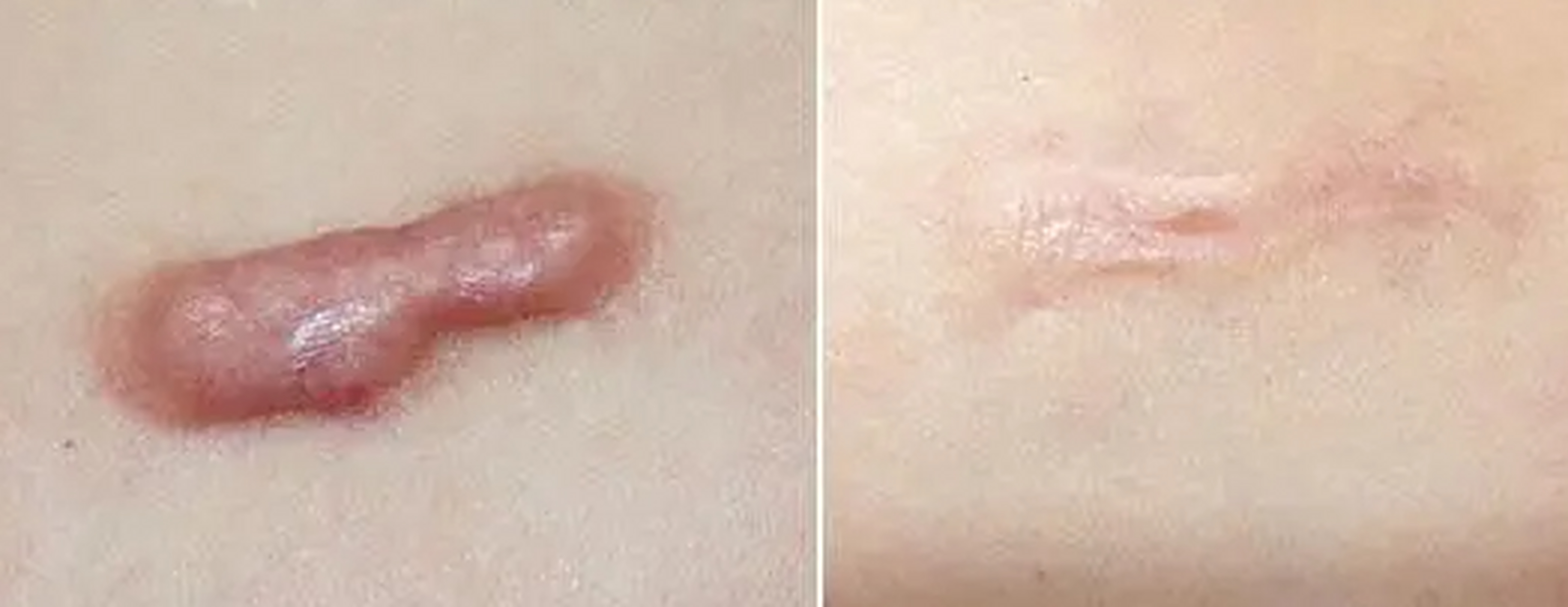 疤痕增生做手术祛疤能去掉吗?