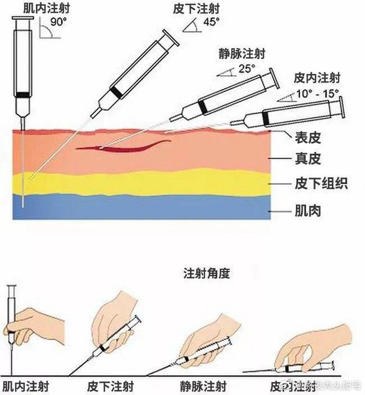 各种注射角度图片