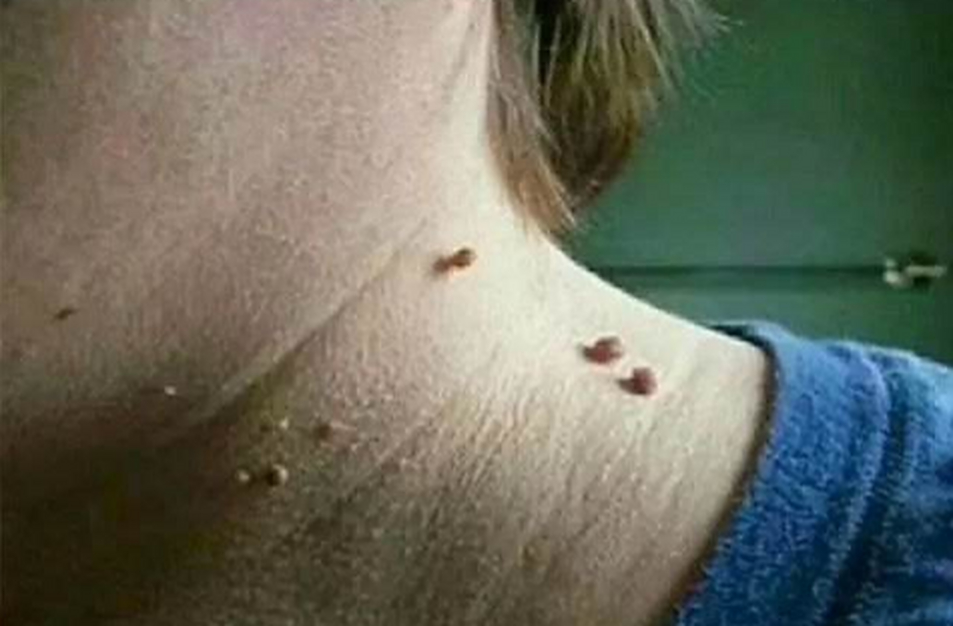 脖子长出了"小肉粒",并非只是影响美观,也许是身体发出的信号  不知道