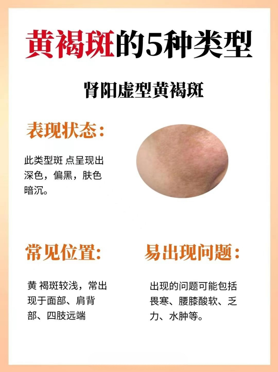 黄褐斑的5种类型,看看你是哪一型? #祛黄褐斑