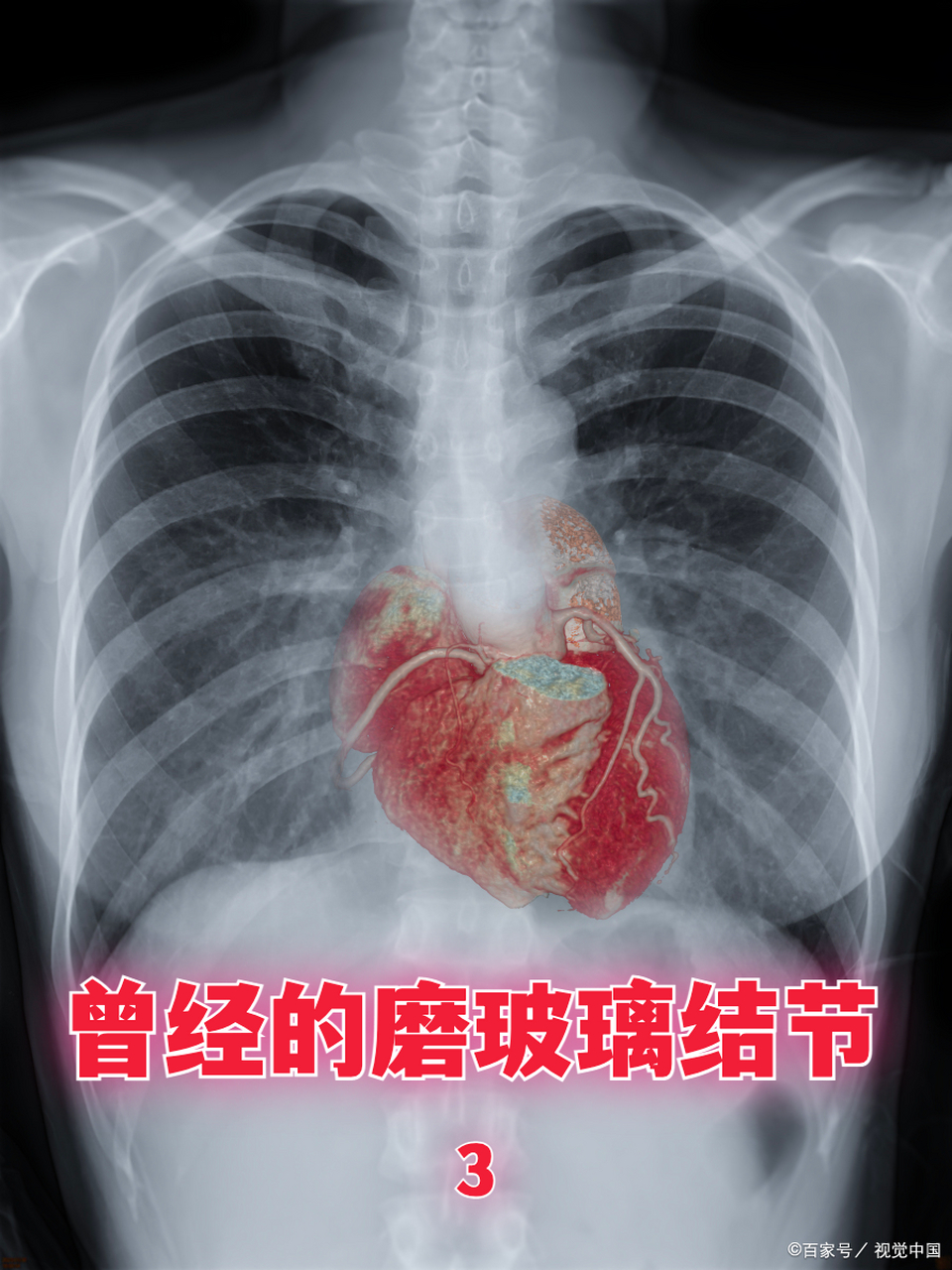 曾经让我寝食难安的左肺下叶26mm磨玻璃结节[撇嘴] 3 #肺结节# #疾病