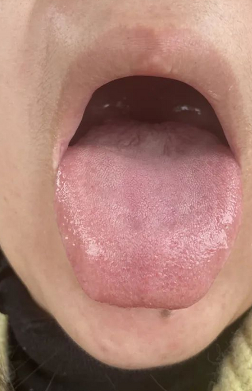 这个舌象首先舌质比较软,舌前突起,舌中凹陷,舌苔薄白.