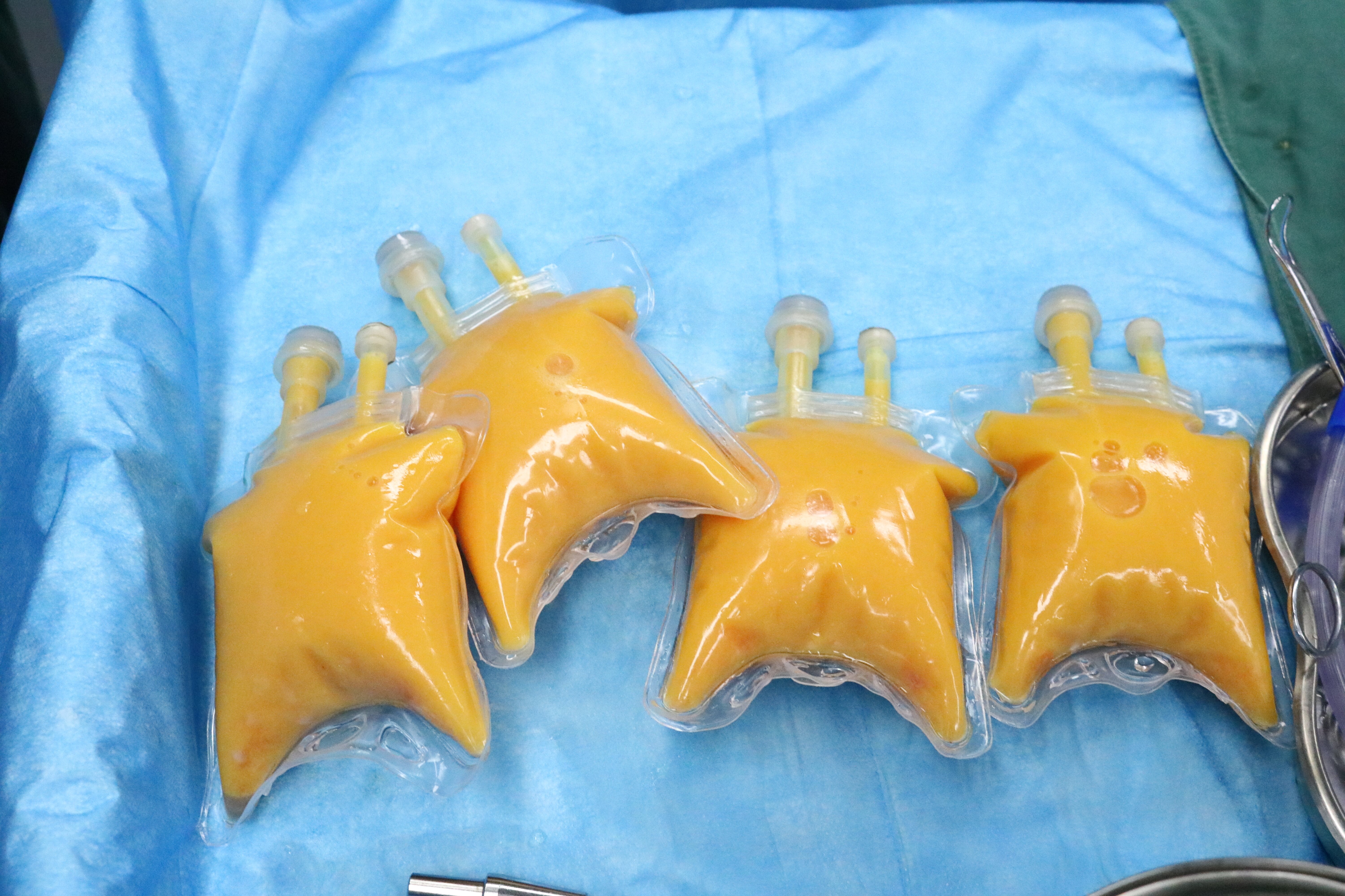 忙碌的一天开始了,这位姑娘的脂肪质量也不错,你们猜猜这四袋脂肪填充