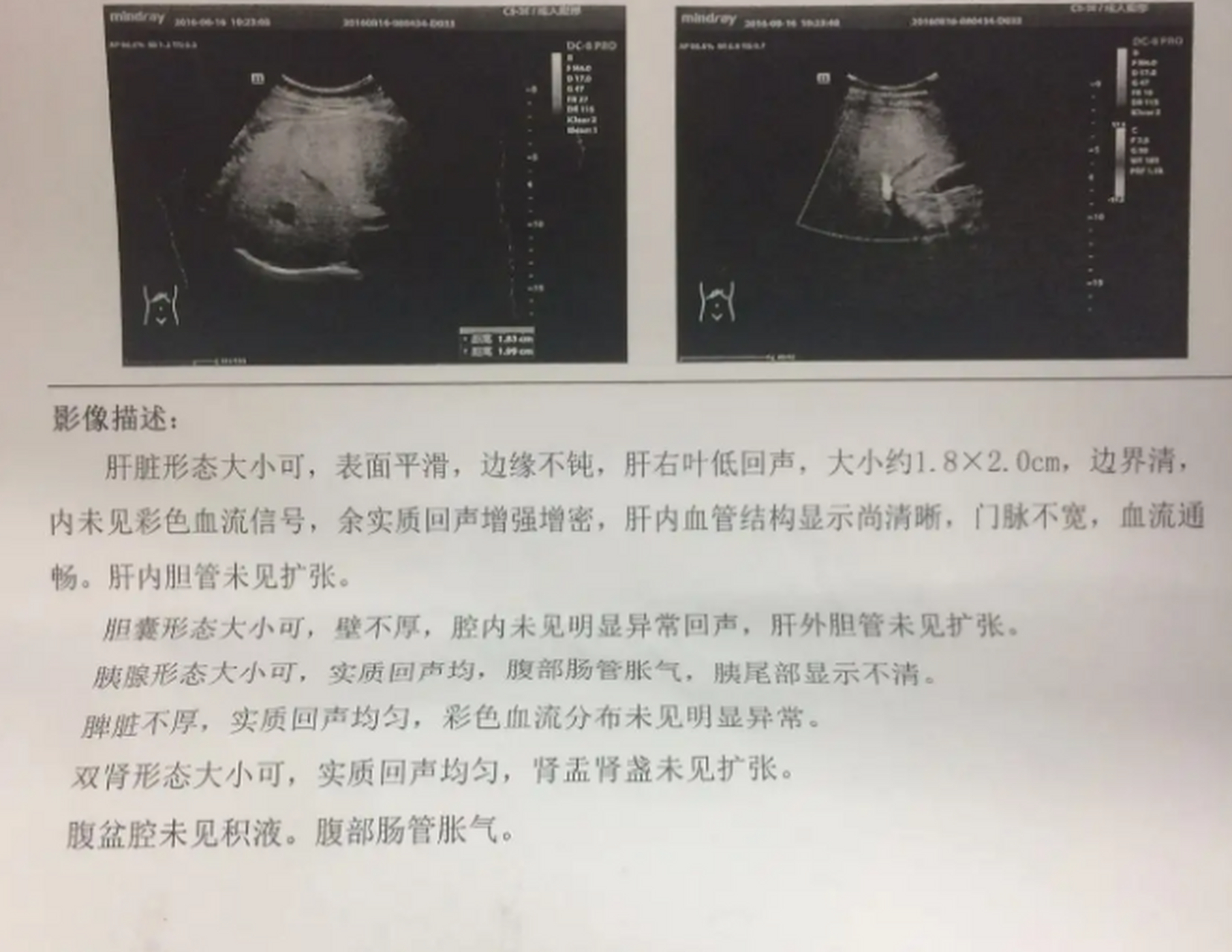 上5个密语 1,回声细密:可能是脂肪肝 2,回声增粗增强:可能是肝纤维化