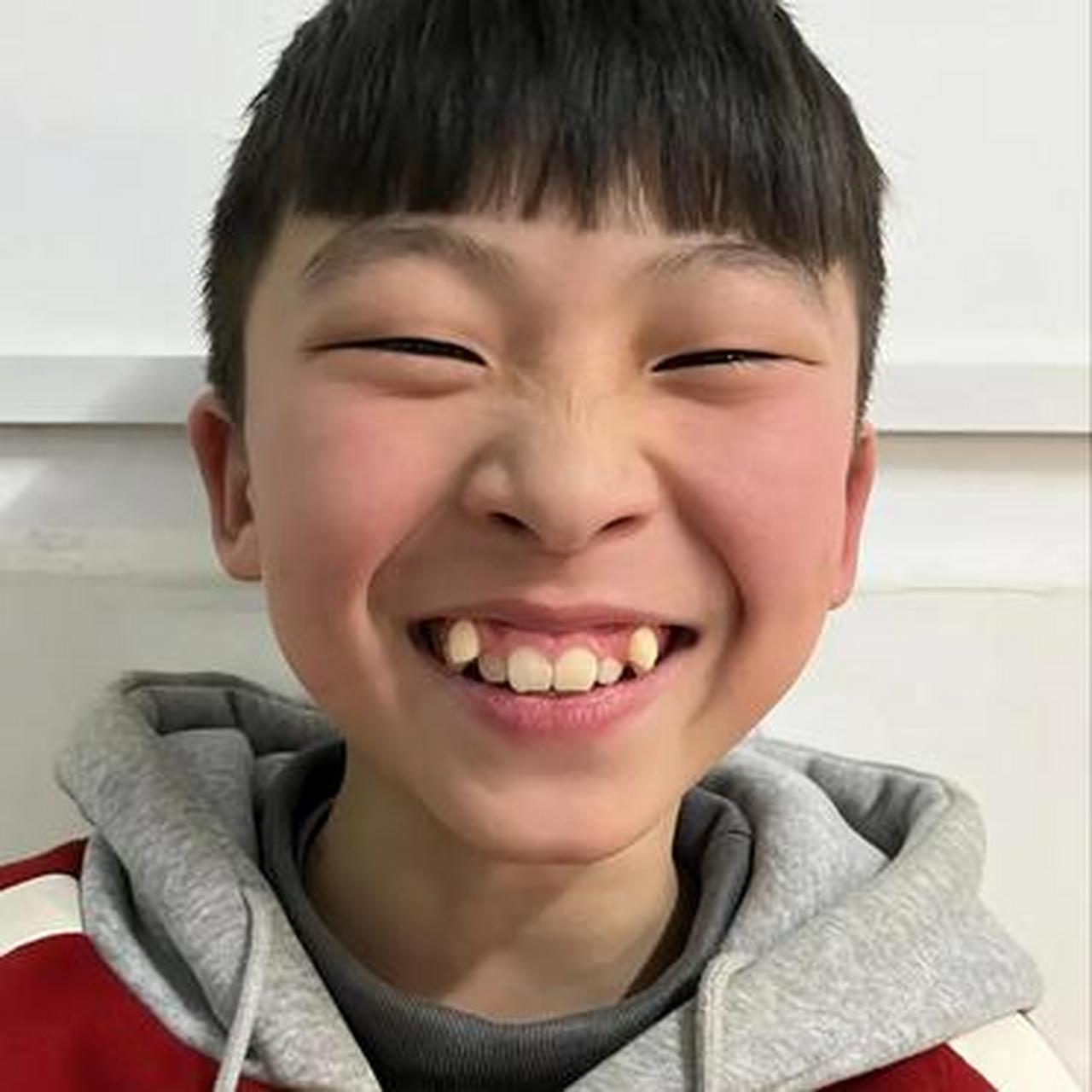 小虎牙矫正后,孩子更帅气了,花点钱,受点罪是值得的.