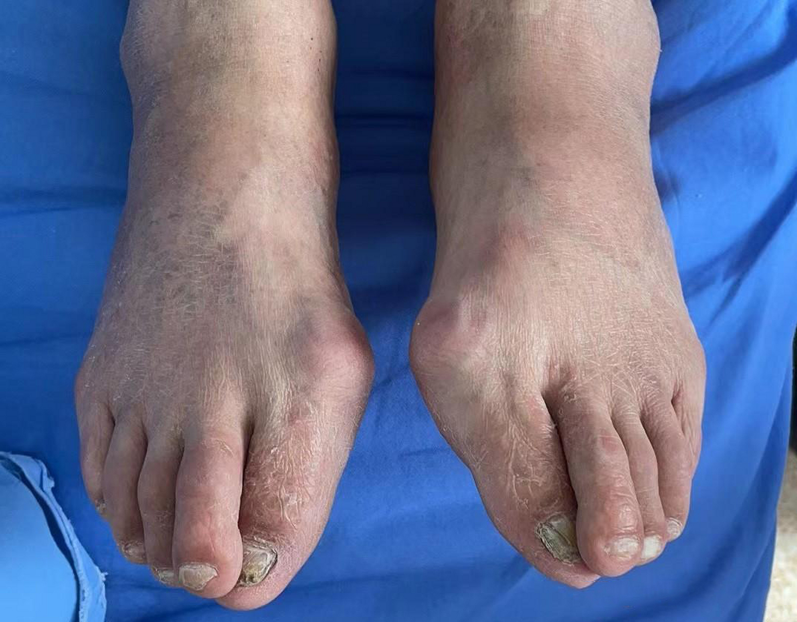 "  "因为您有痛风石在关节处形成.