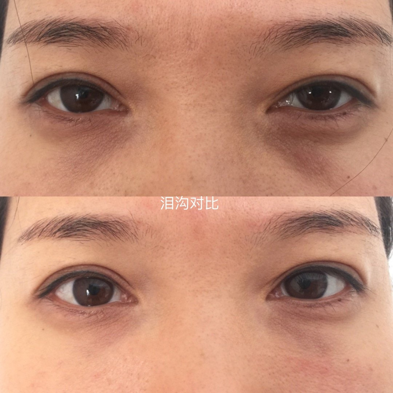 泪沟与眼袋的区别图  眼袋: 眼袋位于距下眼皮2-3cm的地方.