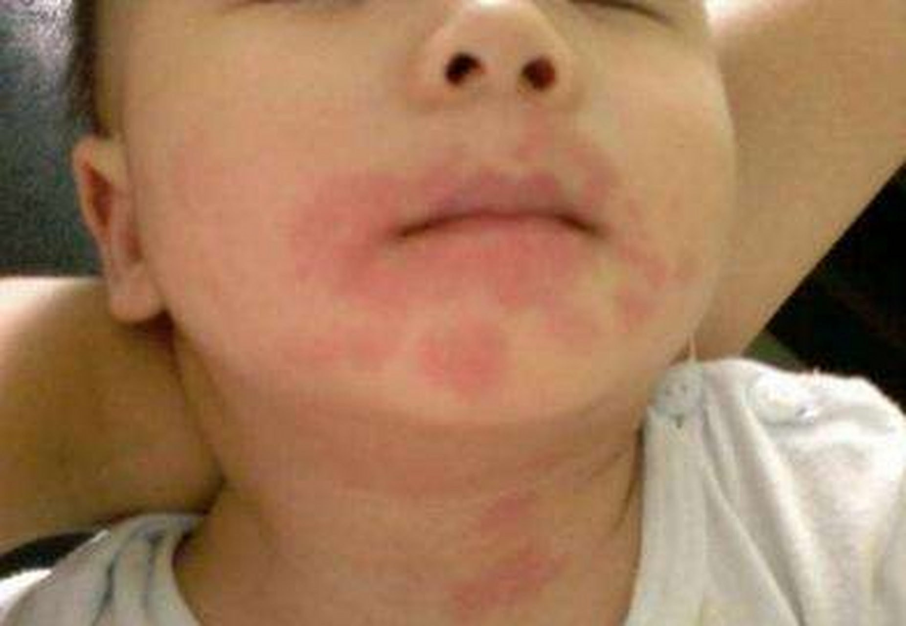 吃芒果过敏的症状中最典型的就是过敏者发生面部红肿的现象