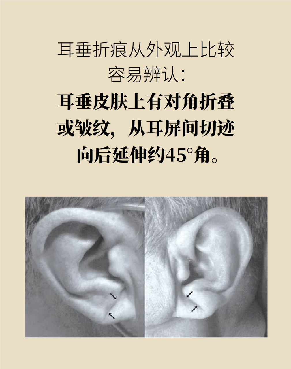 耳垂有折痕要警惕冠心病?