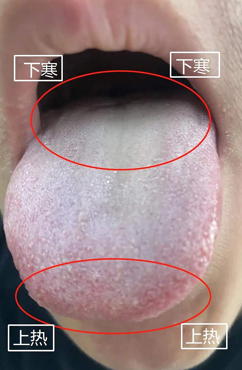 热下寒舌,今天借这个舌像,给大家讲一下看舌五步骤 目前最难受的症状