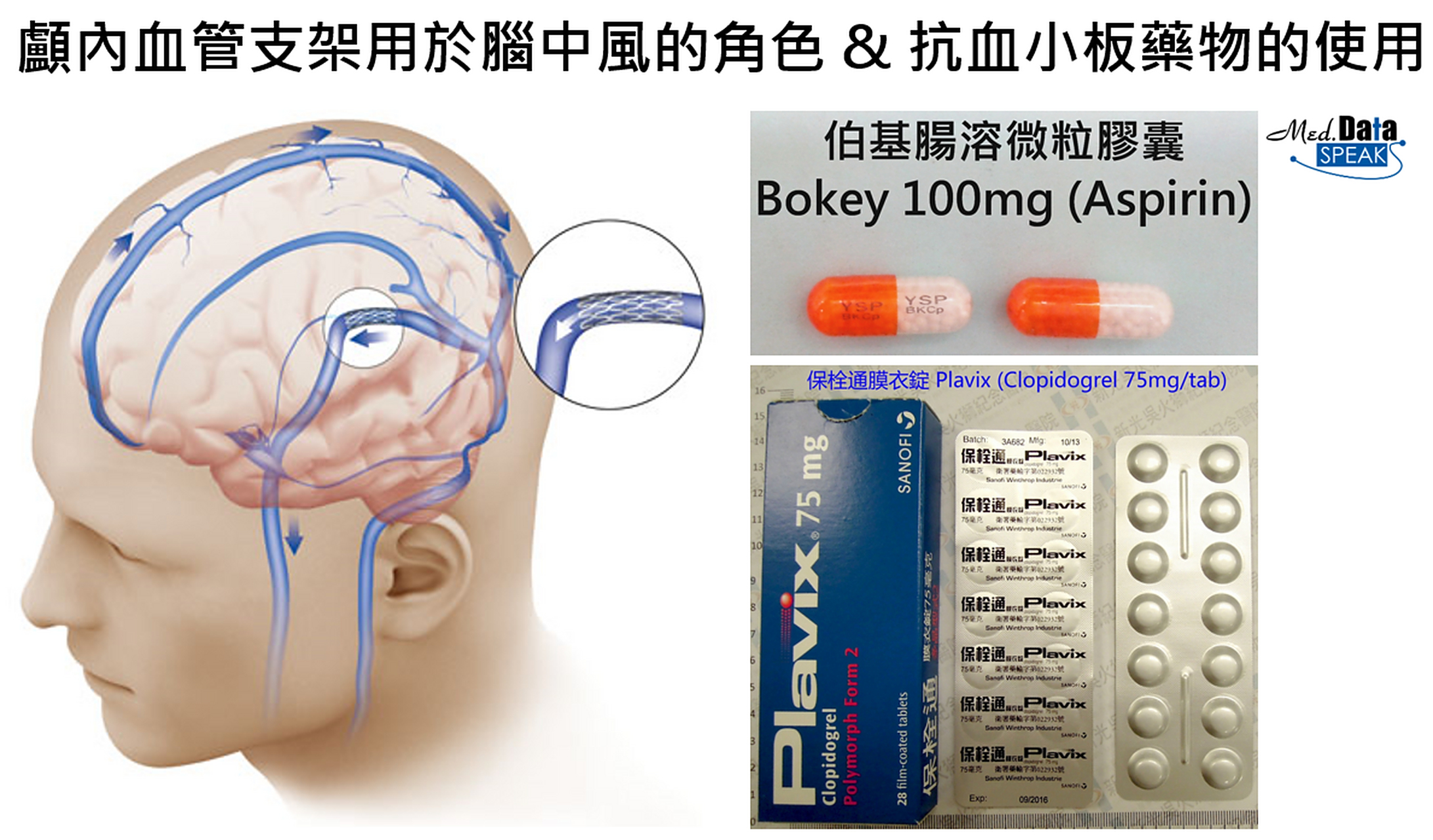 脑血管支架术是指通过介入手段,将一个支架植入到脑血管内,以解决血管