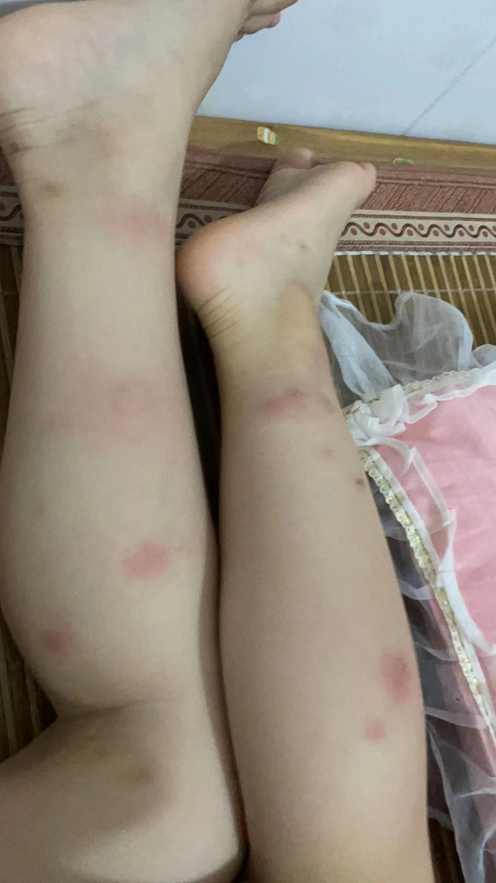 臭虫咬的红包不要再涂花露水了.