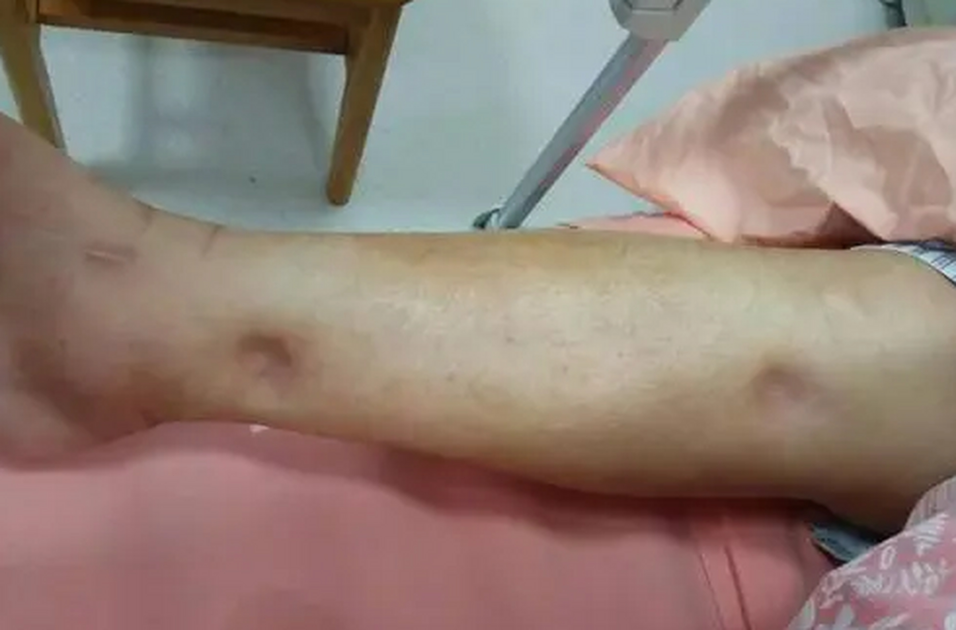 一位患者私信,看看这腿,一按一个坑,蛋白太低了,肝脏的情况也不是很