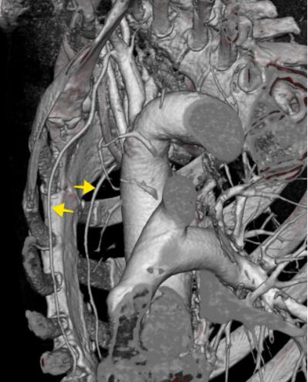 胸廓内动脉(乳内动脉),是心脏搭桥经常使用的动脉.