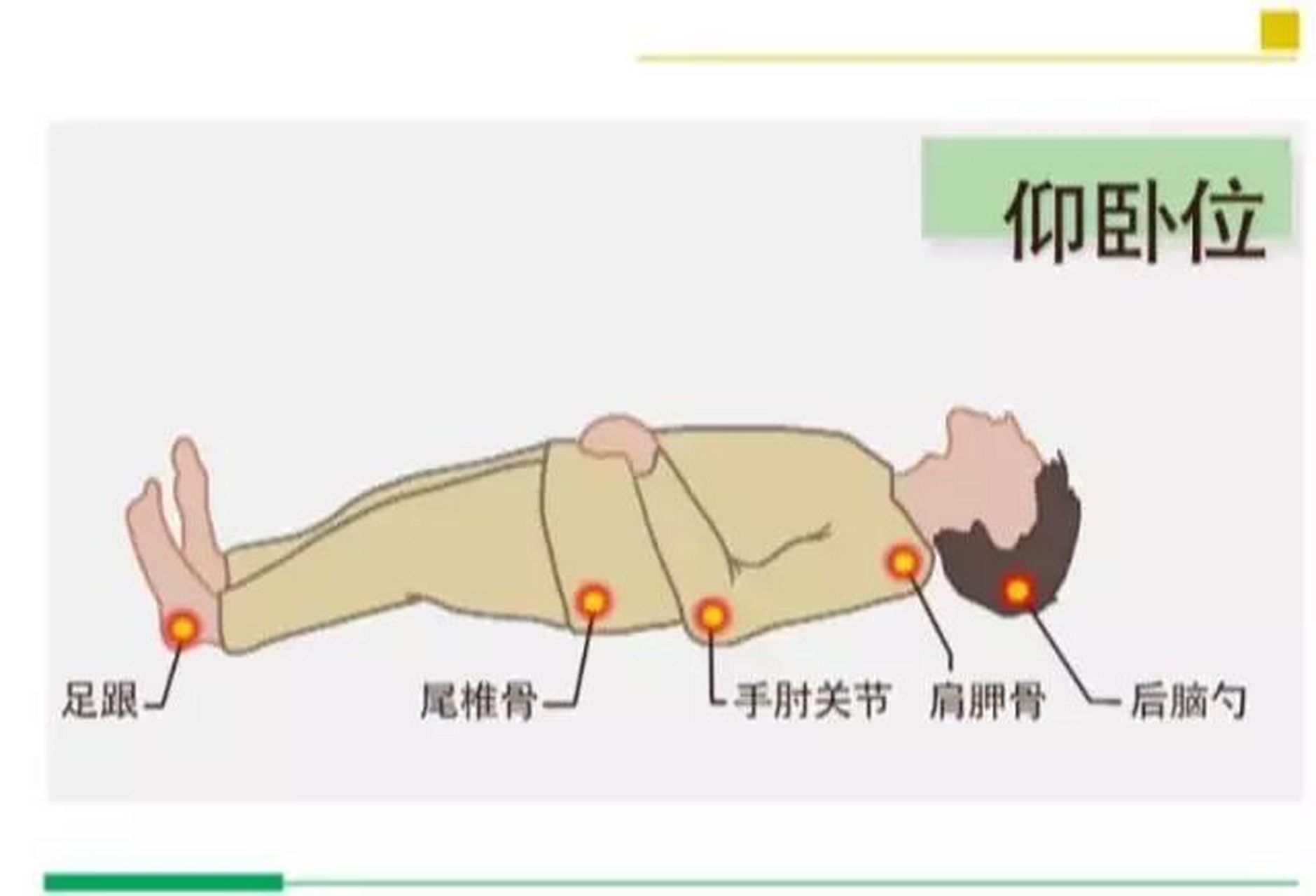 压疮# #褥疮# 各个体位常见压疮部位