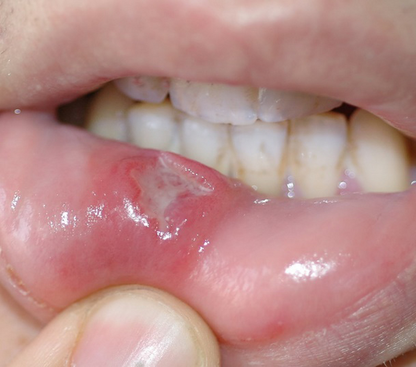 肝火旺和湿气重会导致体内热气增加,从而促使口腔溃疡反复发作.  2.