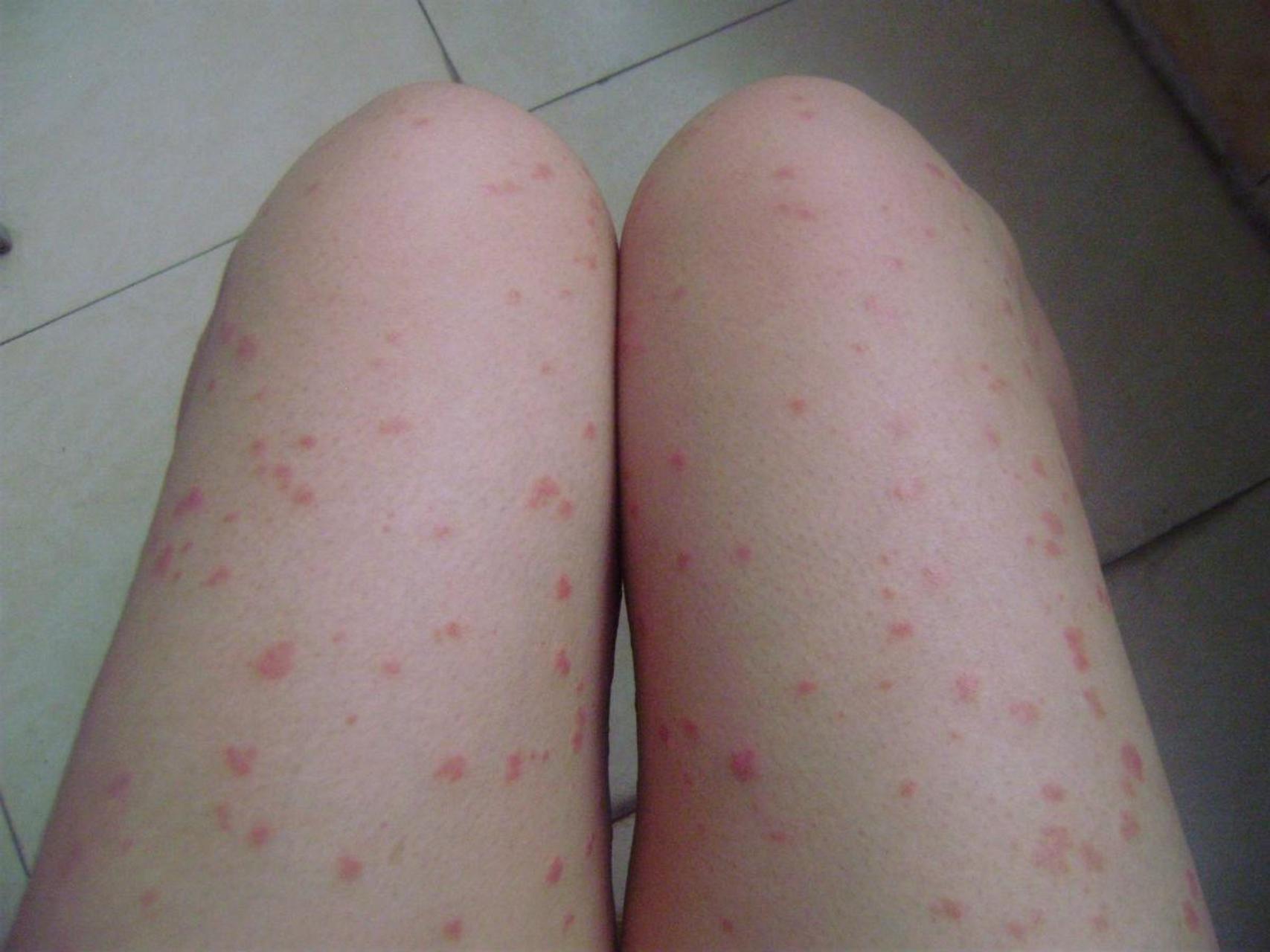 牛皮癣不要忽视这三点  第一是复发前期,一般会有像感冒,发烧,咽痛