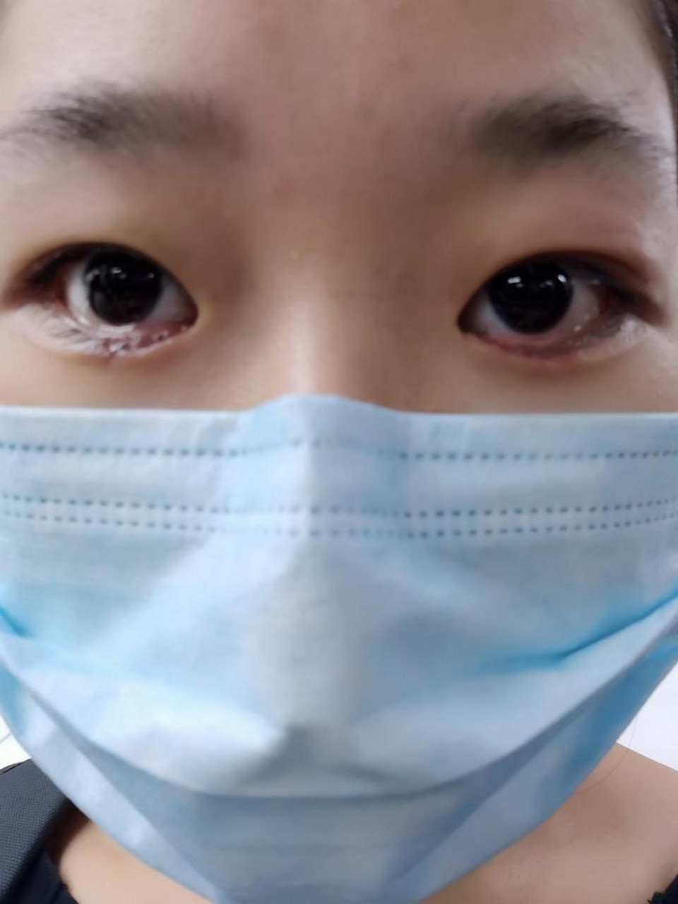 长了倒睫怎么办?  睫毛长到眼睛里面去了,这种情况就是倒睫,很常见.