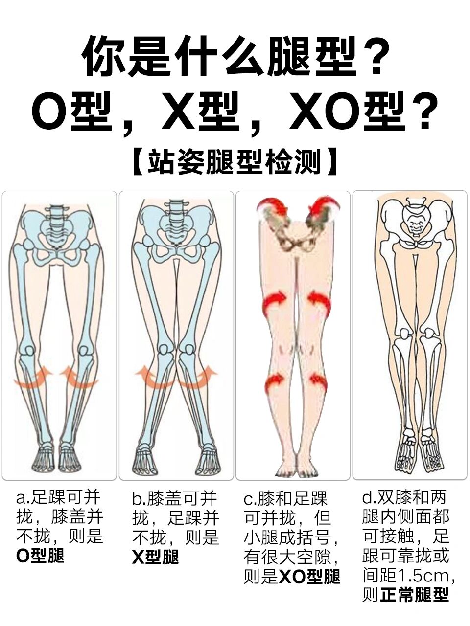 xo型腿矫正方法图解图片