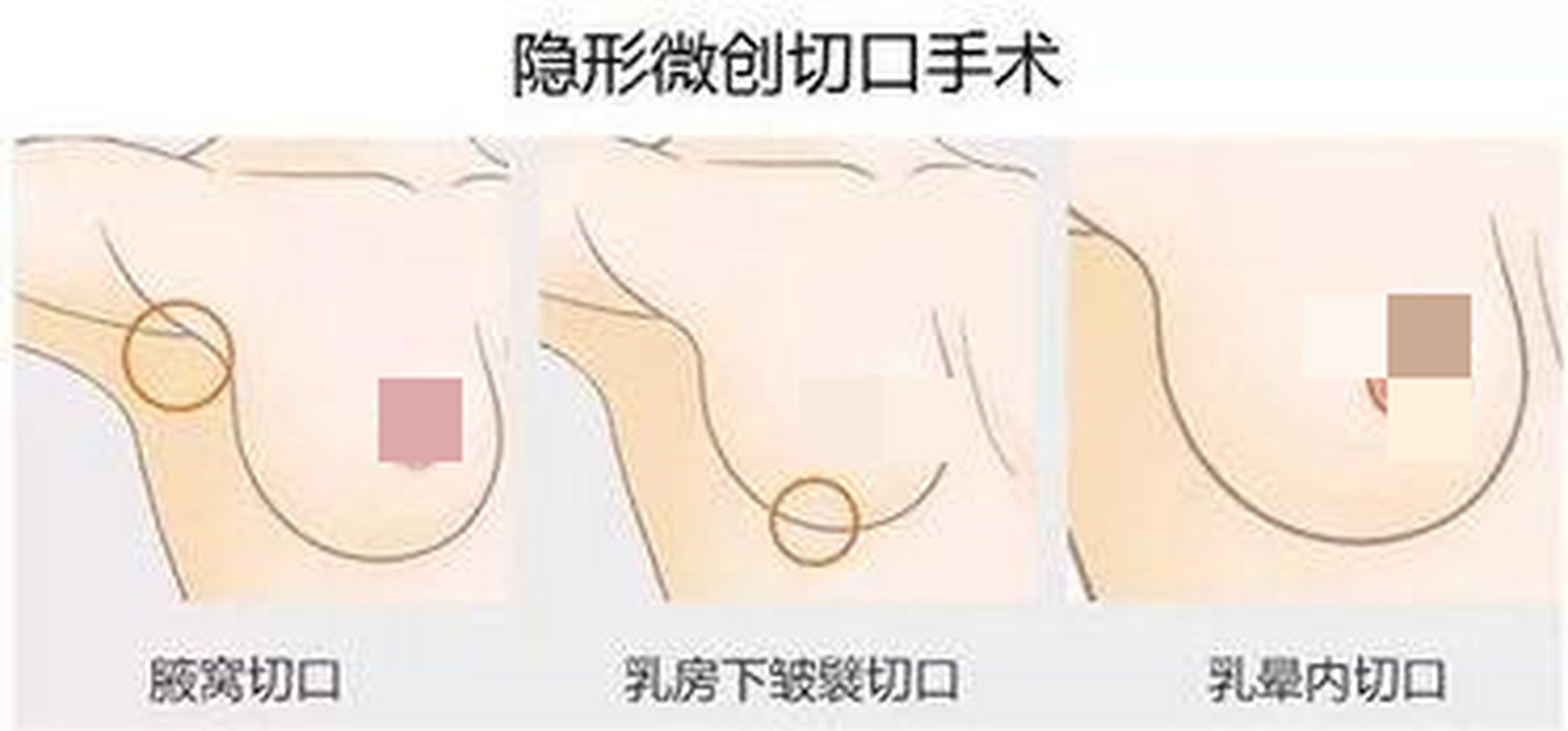 其实,之前的隆胸手术通常会选择腋窝切口,主要是因为这个位置比较