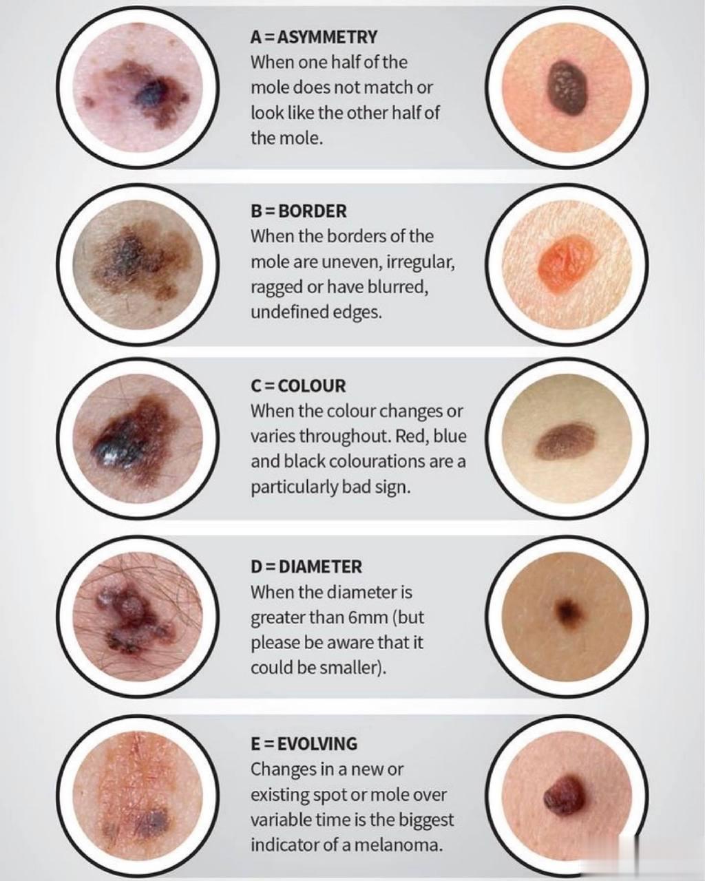 如何判断黑色素瘤皮肤图片