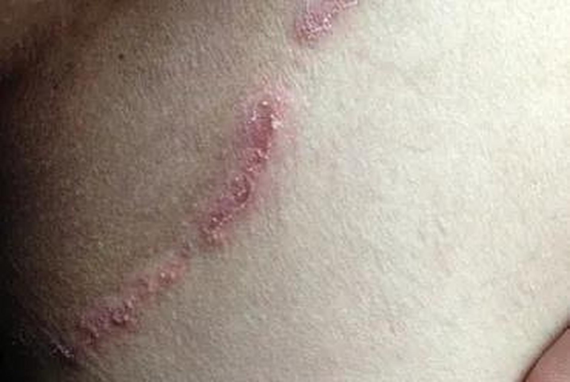 朋友发信息说大腿根痒,家里有两支药膏,但药膏长的很像不知道能用哪个